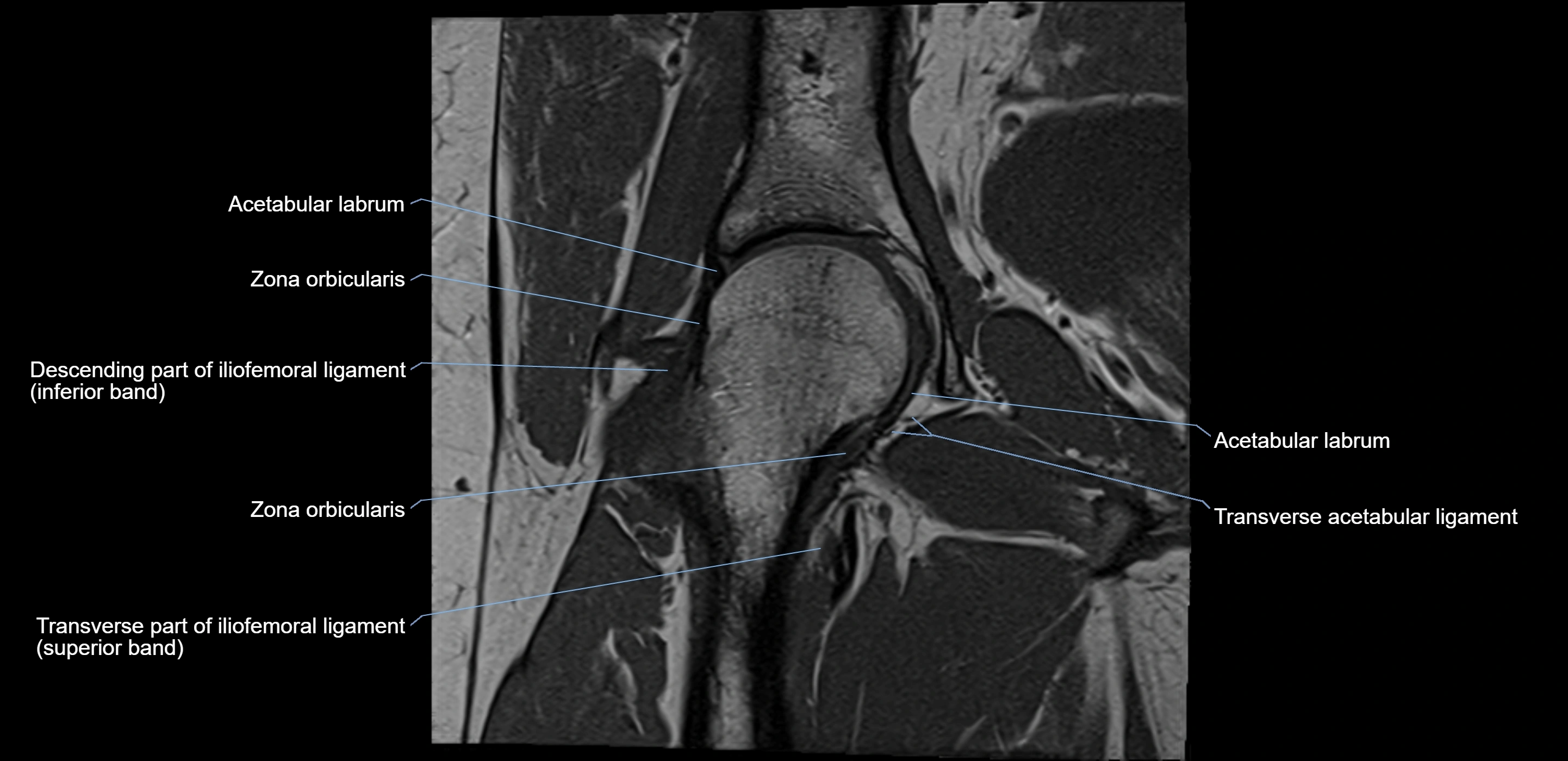 MRI Hip ligaments coronal cross sectional anatomy 3T  radiology  image-img-00001-00011.webp